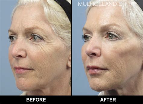 botox face lifting  years younger   minutes spamedica prlog