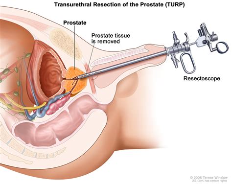 prostate cancer treatment pdq® —patient version national cancer institute