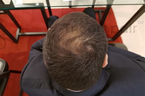 Libera di scegliere se portare i capelli lunghi o corti solo in base al tuo gusto? tricopigmentazione tricorepair capelli lunghi prima - TricoRepair