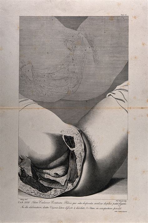 Dissection Of The Female Pelvis Showing Part Of The Rectum And Genital