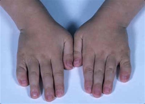 Hand Image Of 49 Xxxxy Syndrome With Associated Finger