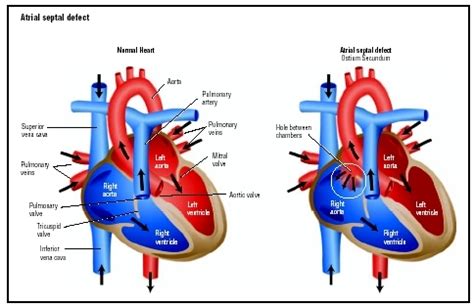 atrial septal defect asd congenital heart defects
