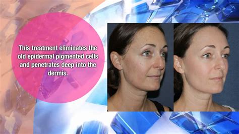 laser skin resurfacing laser east medical spa services call today