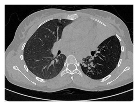 Ct Thorax Showing Left Upper Lobe Collapse And Infiltrations In The
