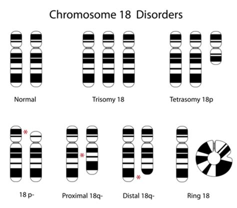 Trisomy 18 Medlineplus Genetics