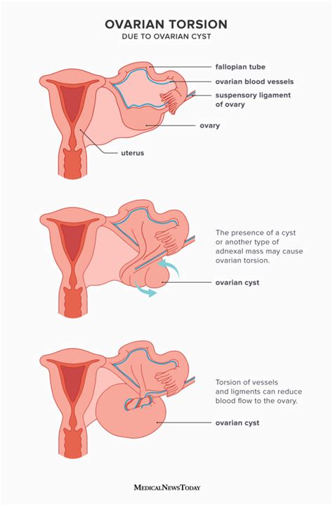 ovarian torsion symptoms  treatment