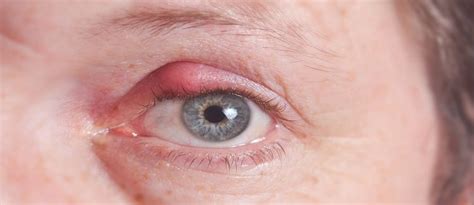 how to treat an eye stye upmc healthbeat