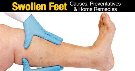 Swollen Feet Causes Preventatives And Home Remedies