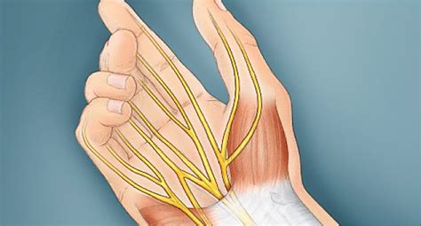 Carpal Tunnel Syndrome Pictures Anatomy Where It Hurts And More