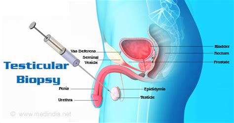 Sexual and reproductive health awareness day