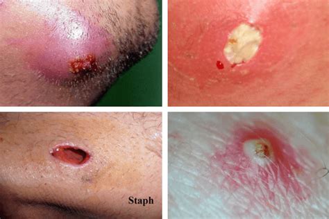 infected ingrown hair  pictures cysts staph treatment