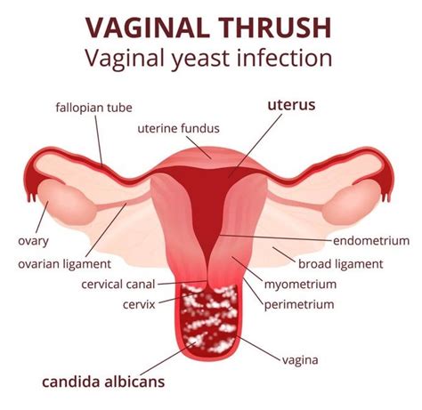 Vaginal Yeast Infection Candidiasis Symptoms Causes