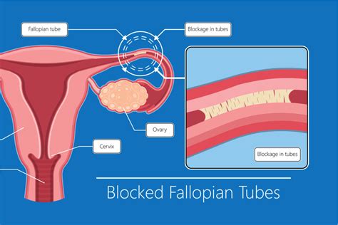 fallopian tube function obstruction definition video  xxx