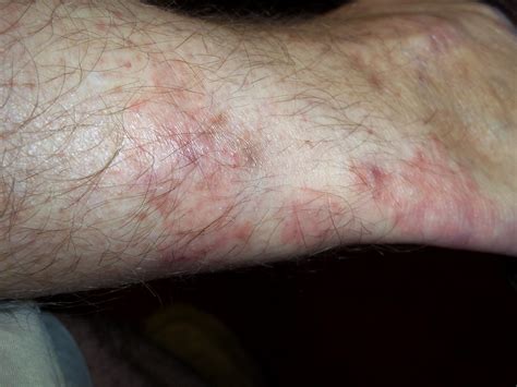 rash      leg    ankle