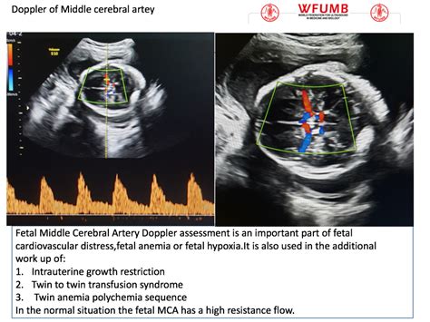 ultrasound    doppler   fetal middle   cerebral artery wfumb