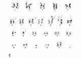 Karyotype Abnormal Chromosome Abnormalities Above sketch template