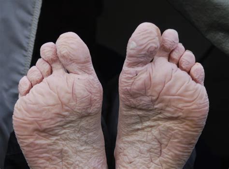 Disease On Bottom Of Foot Porn Pics And Movies