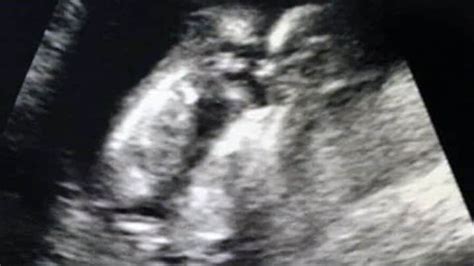 12 weeks pregnant with twins belly symptoms and ultrasound pictures