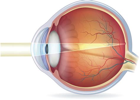 vision  work lasik denver cataract surgery