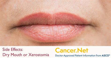 dry mouth or xerostomia cancer