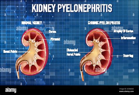 informative illustration  pyelonephritis illustration stock vector