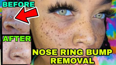 remove nose ring bump fast  nose ring experience youtube