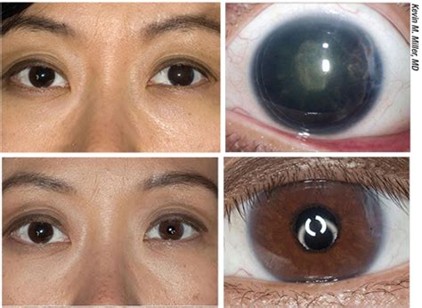 eye color implants eye color photos
