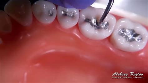 Carving My First Class I Dental Amalgam Restoration Asmr