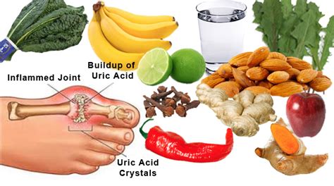 Diet Chart For High Uric Acid Condition Symptoms And Treatments