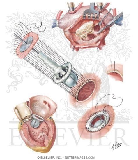 Valve Replacement Open Heart Surgery Mitral Valve Replacement