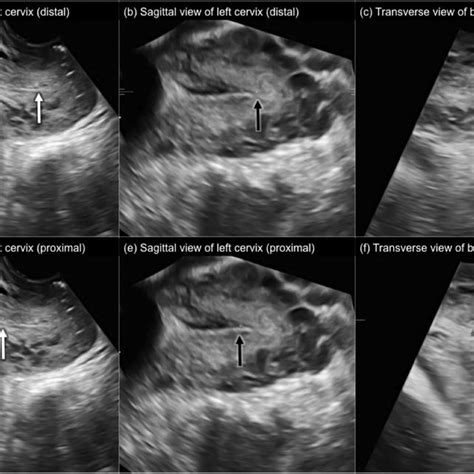 Intraoperative Photos Of Uterus Didelphys During Cesarean Section A