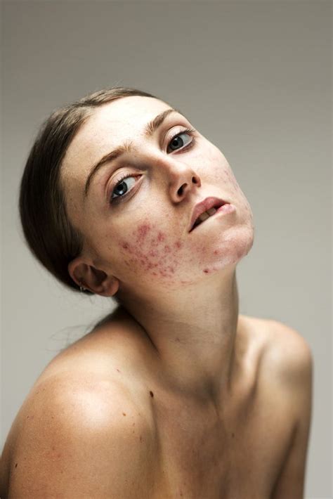 Photo Series Shows Women S Real Skin From Acne To Rosacea