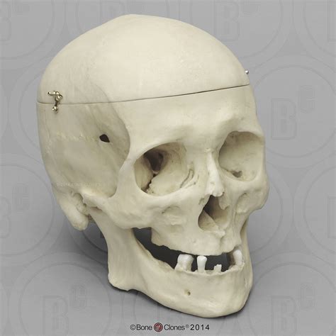 Human Male Skull 22 Caliber Bullet Wound With Calvarium