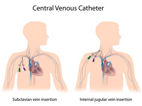central venous catheter placement portland and oregon city