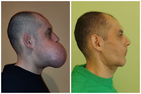 man   pound tumor successfully removed  face   years