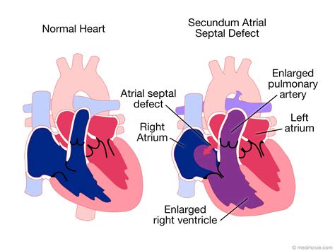atrial septal defect normal heart infancy pulmonary arteries atrium asd early childhood