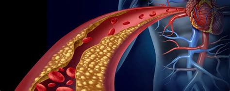 bad cholesterol ldl