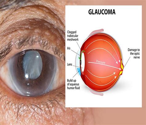 glaucoma  symptoms treatment diagnosis  prevention