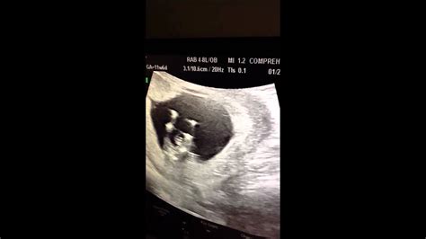 11 weeks 6 days ultrasound youtube