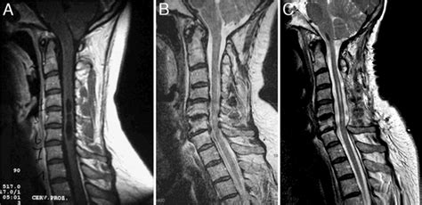 Chiari I Malformation With And Without Basilar Invagination A