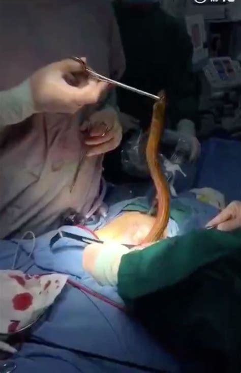 disgusting footage shows live eel being removed from patient s body during operation mirror online