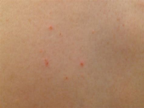 small red itchy bumps   body started  midsection