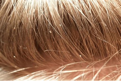 18 natural remedies to get rid of head lice best health tips