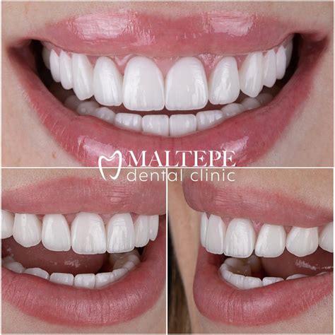 perfect teeth       maltepe dental clinic