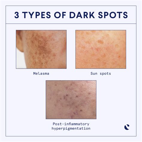 brown spots   face experts explain