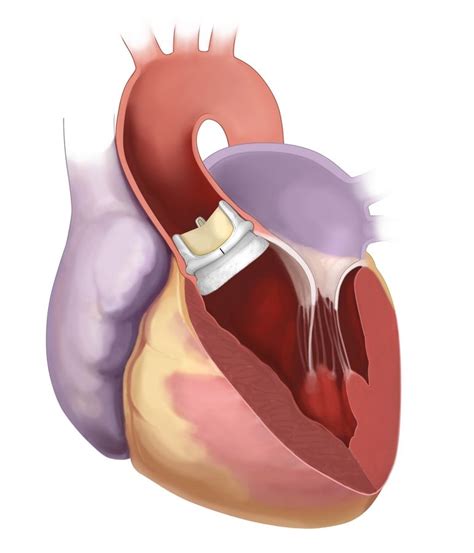 New Aortic Valve System At Central Dupage Offers Less Invasive