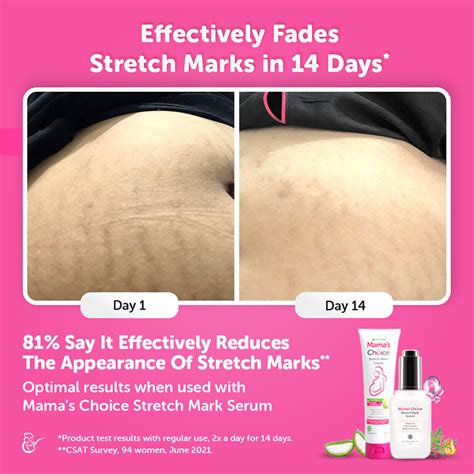 The Results Behind Mamas Choice Stretch Mark Cream