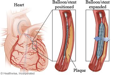 learning  percutaneous coronary intervention