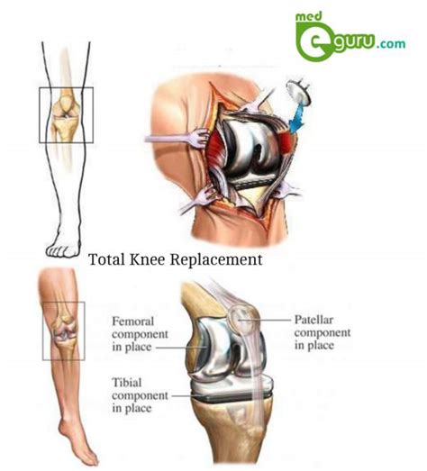 total knee replacement surgery knee arthroplastymed e guru