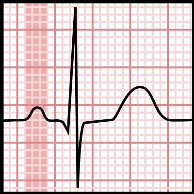 p wave electrocardiography wikipedia